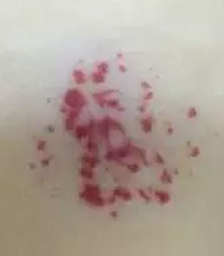 血管瘤,胎记