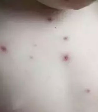 湿疹,婴儿湿疹,痱子