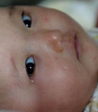 双胞胎,女婴,同患白血病